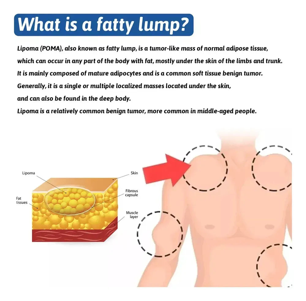 LIPOMA REMOVAL CREAM(IMPORTED)