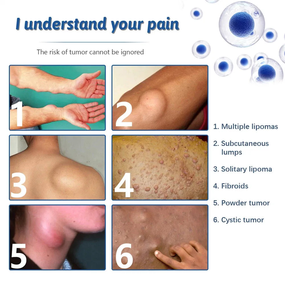 LIPOMA REMOVAL CREAM(IMPORTED)