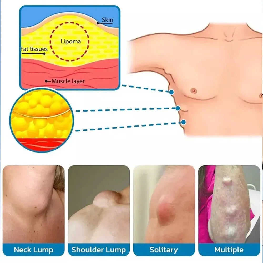 LIPOMA REMOVAL CREAM(IMPORTED)